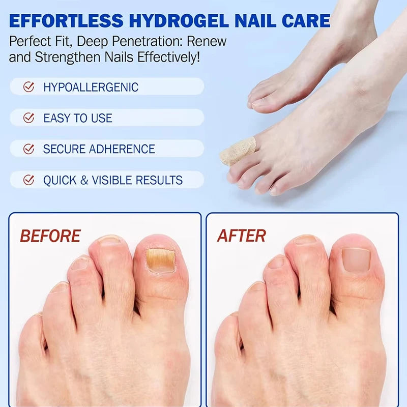 Nail Fungus Patch Waterproof Nail Repair Patch Ingrown Correction Sticker Damaged Nail Gray Care Patch Feet Care Tools