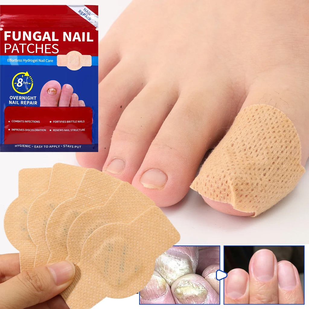 Waterproof Nail Fungus Patch Ingrown Toenail Correction Sticker Damaged Gray Nail Repair Care Feet Tools