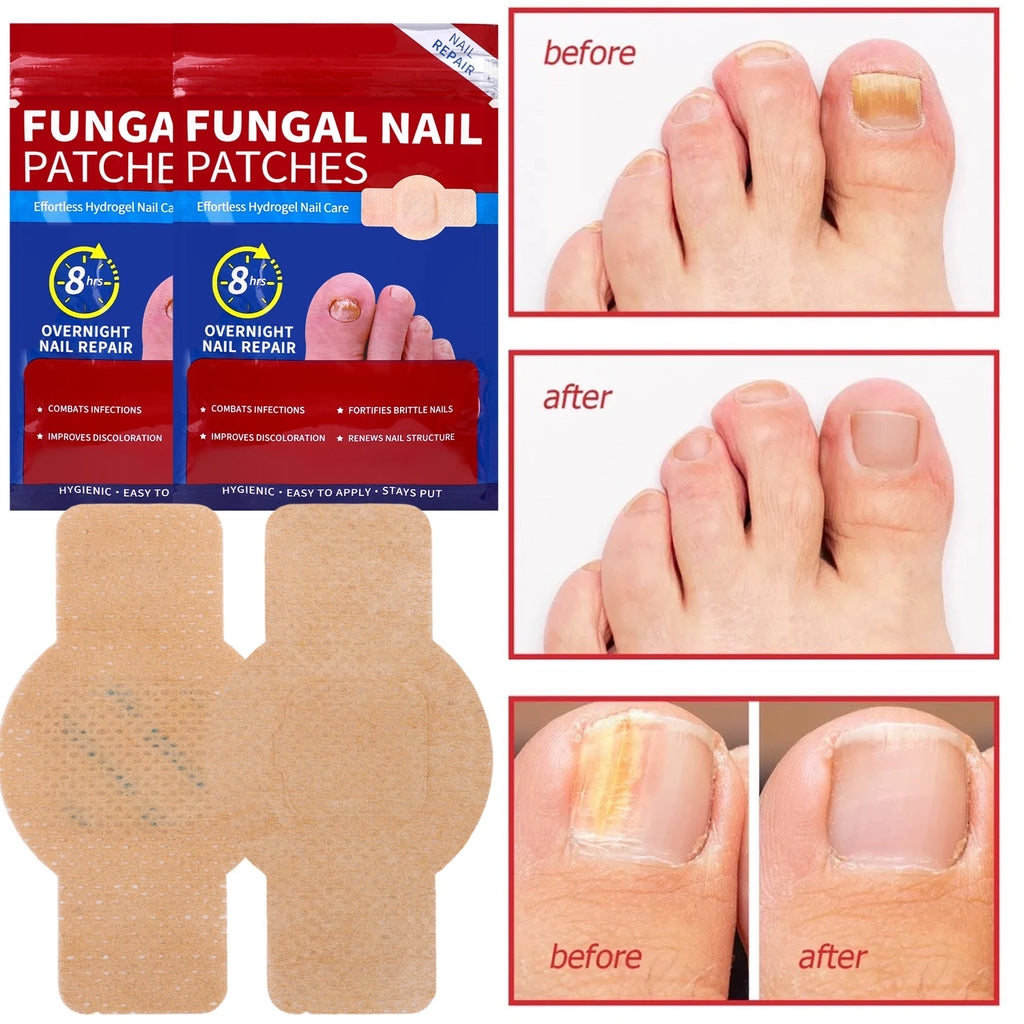 Waterproof Nail Fungus Patch Ingrown Toenail Correction Sticker Damaged Gray Nail Repair Care Feet Tools