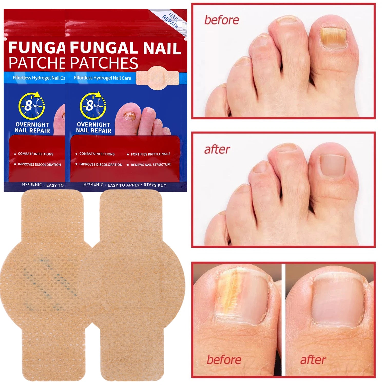 Waterproof Nail Fungus Patch Ingrown Toenail Correction Sticker Damaged Gray Nail Repair Care Feet Tools